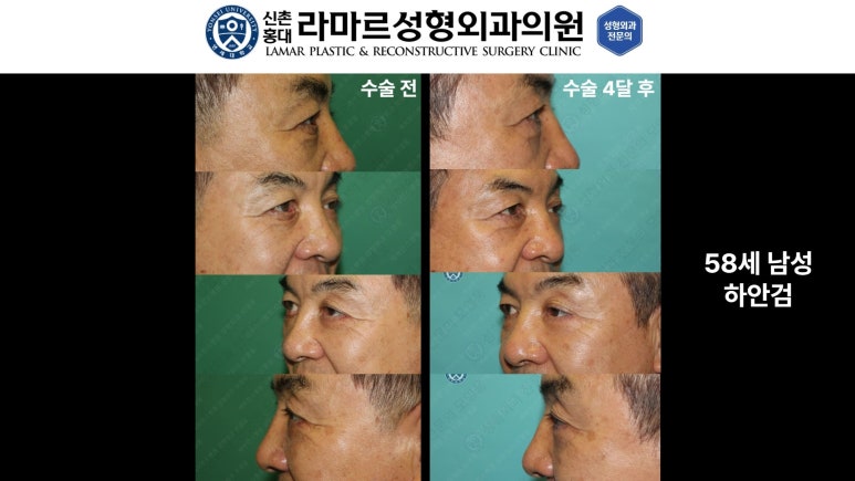 30대~80대 눈 수술 케이스 : 하안검성형술 전후 사진 모음 관련 이미지 53