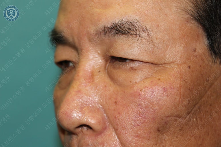 67세 남성, 상&middot;하안검성형술 및 안검하수교정 (67/M, Upper &  lower blepharoplasty with ptosis correction) 관련 이미지 13