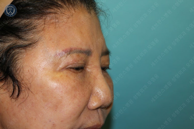 71세 여성, 이마거상술과 이마축소술 (71/F, Forehead lift and reduction) 관련 이미지 8