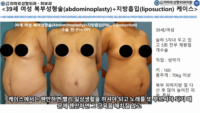 '복부성형술+지방흡입(Abdominoplasty+PAL)' 으로 뱃살 끝장내기! 관련 이미지 31