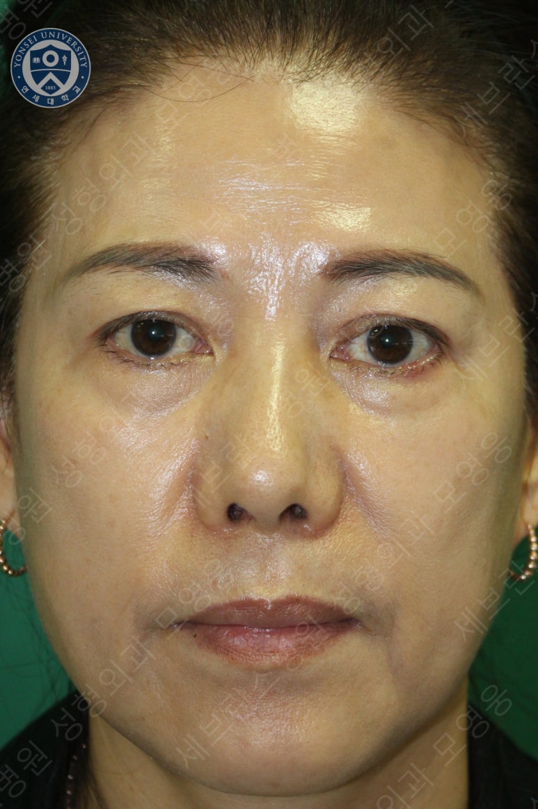 59세 여성, 그레이브스 안병증이 있는 돌출눈 중년 여성 하안검 성형술 (Lower blepharoplasty in Graves 관련 이미지 4