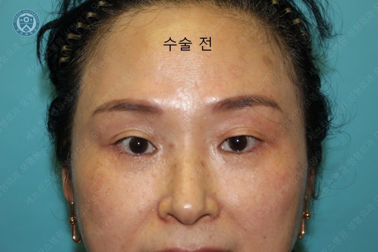 49세 여성, 토안이 있는 중년여성의 상안검성형술 (49/F, Upper blepharoplasty with lagophthalmos correction& LP) 관련 이미지 3