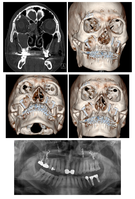 57세 남성, 얼굴 전체골절(57/M Panfacial bone fracture) 수술 및 흉터관리 증례 관련 이미지 15