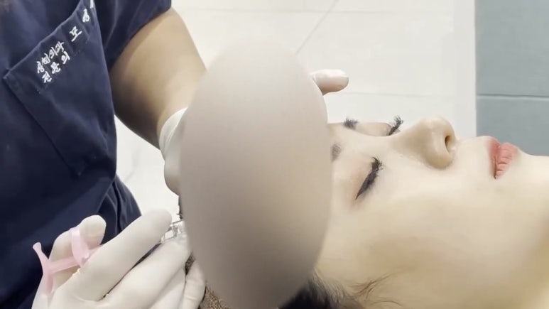 이마필러 : 21세 여성 이마필러 시술영상 관련 이미지 8