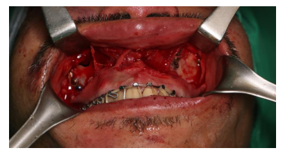 57세 남성, 얼굴 전체골절(57/M Panfacial bone fracture) 수술 및 흉터관리 증례 관련 이미지 9
