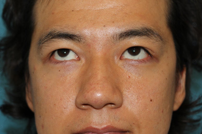 27세 남성 무쌍(속쌍)눈매교정 (27/M Ptosis correction with double lid plasty) 관련 이미지 32