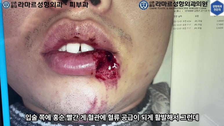 개에 물려 입술 1/3이 뜯긴 19세 남자분 치료 및 흉터 성형수술& 레이저 후기....! 관련 이미지 18