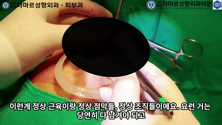 파라핀 필러 입 안 절개로 흉터없이 빼내기! 관련 이미지 73