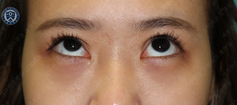 17세 여성, 비절개 눈매교정 및 앞트임 재수술 (17/F NI ptosis correction & Med. epicanthoplasty revision) 증례 관련 이미지 16