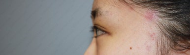 17세 여성, 쌍꺼풀+앞트임(DEO+Medial epicanthoplasty) 관련 이미지 20