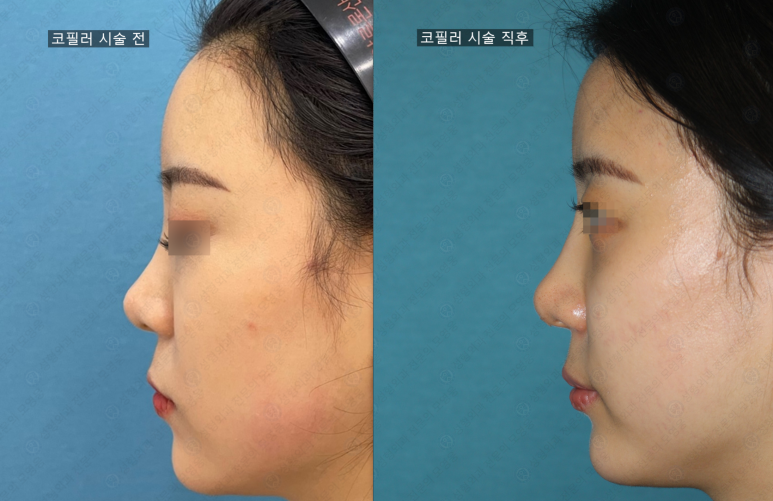 20대 여성 코필러 시술 영상 관련 이미지 16