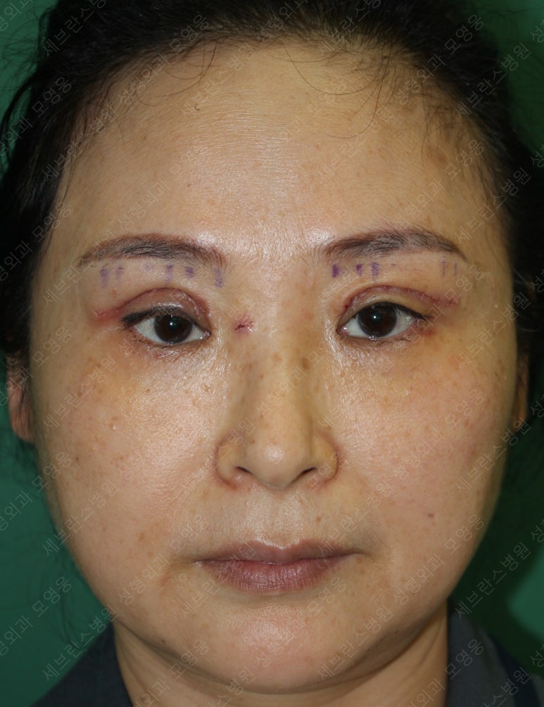 49세 여성, 토안이 있는 중년여성의 상안검성형술 (49/F, Upper blepharoplasty with lagophthalmos correction& LP) 관련 이미지 16