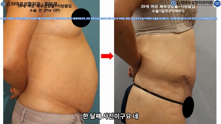 '복부성형술+지방흡입(Abdominoplasty+PAL)' 으로 뱃살 끝장내기! 관련 이미지 57
