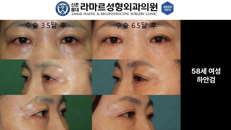 30대~80대 눈 수술 케이스 : 하안검성형술 전후 사진 모음 관련 이미지 31