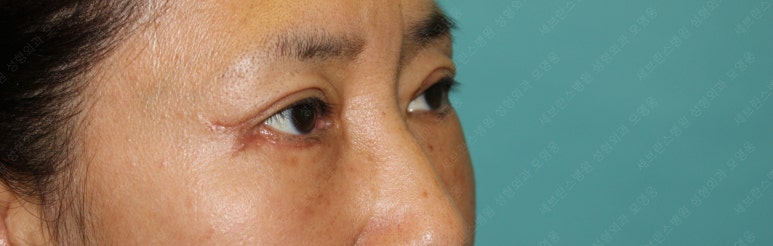 55세 여성, 상안검 및 하안검 성형술 증례 (55/F Upper & lower blepharoplasty) 관련 이미지 18