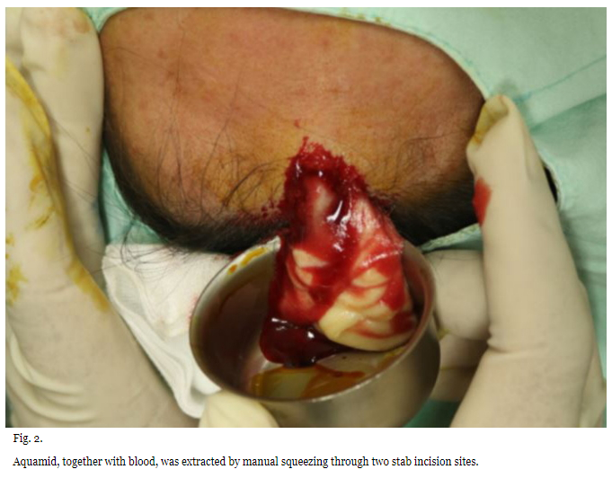 AAPS-Polyacrylamide hydrogel (Aquamid) filler removal after a decade 관련 이미지 4