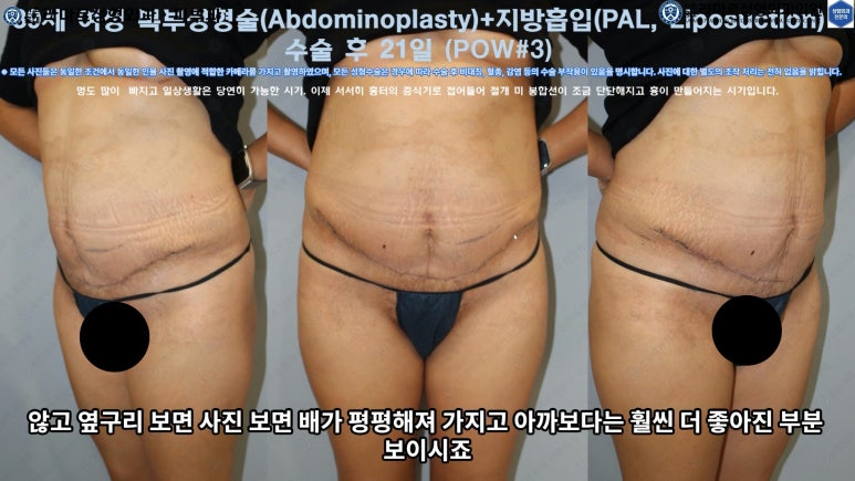 '복부성형술+지방흡입(Abdominoplasty+PAL)' 으로 뱃살 끝장내기! 관련 이미지 48