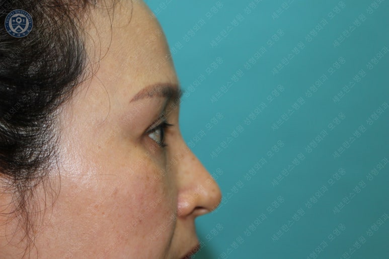 49세 여성, 토안이 있는 중년여성의 상안검성형술 (49/F, Upper blepharoplasty with lagophthalmos correction& LP) 관련 이미지 40