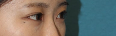 17세 여성, 쌍꺼풀+앞트임(DEO+Medial epicanthoplasty) 관련 이미지 28