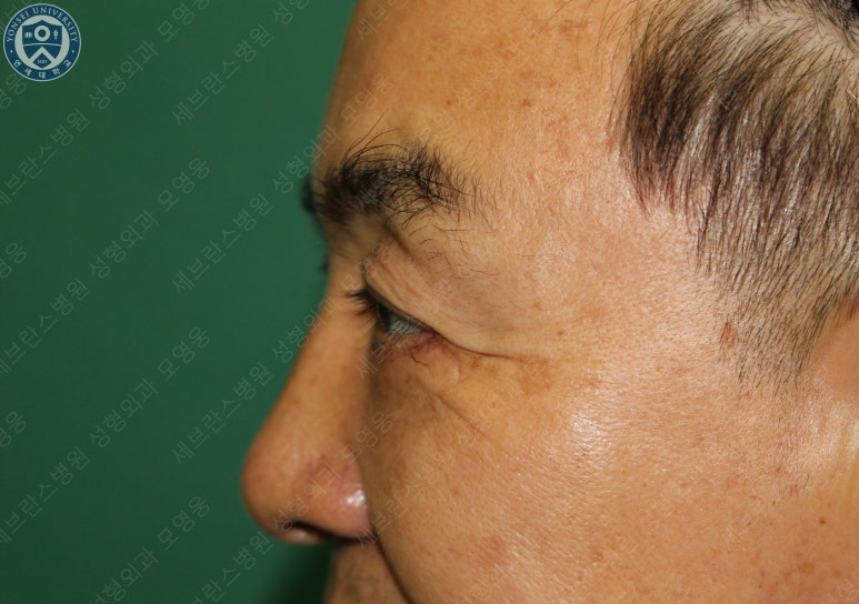 68세 남성, 하안검 성형술 및 안검외반 교정 증례(68/M Lower blepharoplasty & Ectropion correction with triamcinolone) 관련 이미지 9