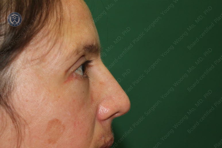 38세 서양 백인 여성, 쌍꺼풀 수술과 눈매교정 및 하안검성형술 (38/F Upper&lower blepharoplasty with levator plication) 관련 이미지 36