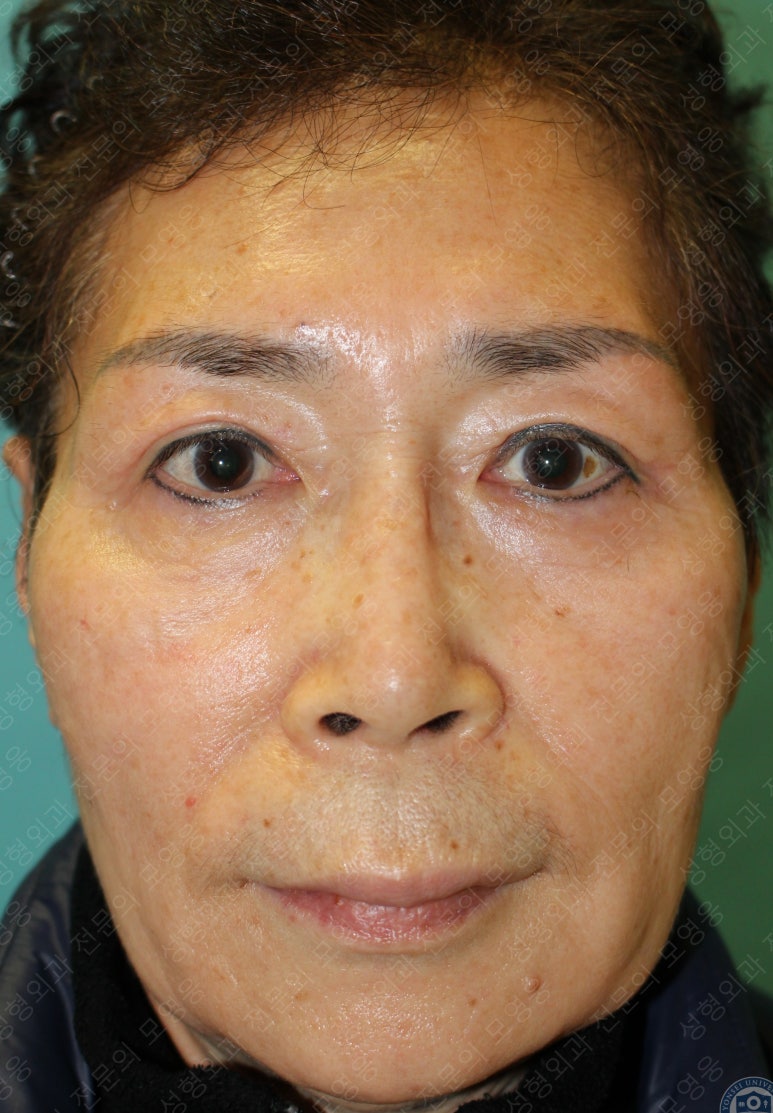 64세 여성 상안검성형술+눈매교정 (64/F Upper blepharoplasty with ptosis correction) 관련 이미지 26