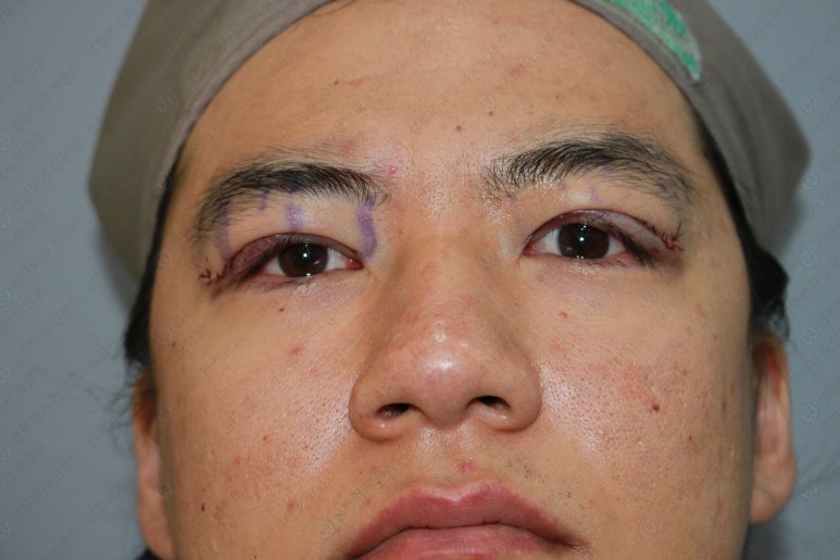 27세 남성 무쌍(속쌍)눈매교정 (27/M Ptosis correction with double lid plasty) 관련 이미지 14