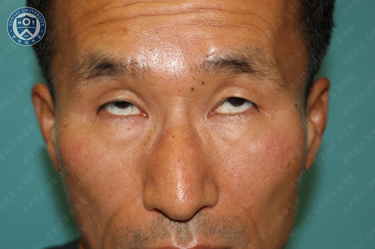 남자눈성형: 무쌍눈매교정 (Blephroptosis correction-levator aponeurosis advancement) 관련 이미지 13