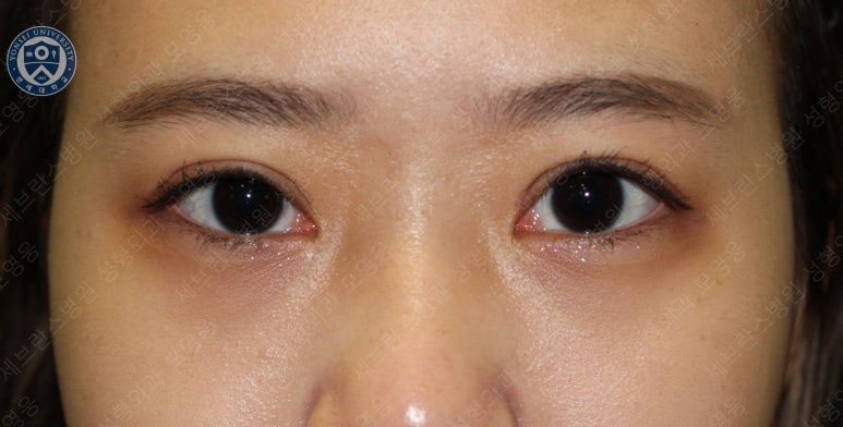 17세 여성, 비절개 눈매교정 및 앞트임 재수술 (17/F NI ptosis correction & Med. epicanthoplasty revision) 증례 관련 이미지 14
