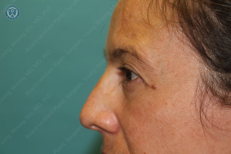 38세 서양 백인 여성, 쌍꺼풀 수술과 눈매교정 및 하안검성형술 (38/F Upper&lower blepharoplasty with levator plication) 관련 이미지 6