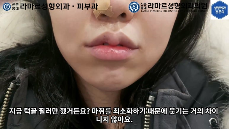 지름 1cm 코 점 제거수술 : 나선피판술(Spiral Flap) 수술전~1달 경과. (Feat. 턱끝필러+사각턱 보톡스) 관련 이미지 112