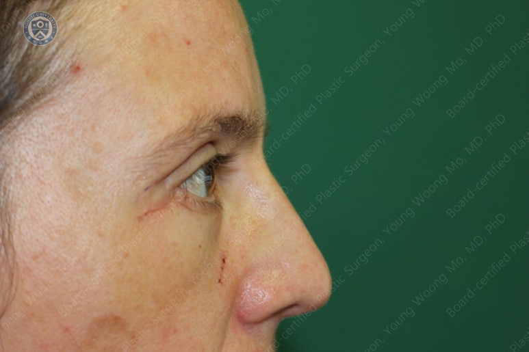 38세 서양 백인 여성, 쌍꺼풀 수술과 눈매교정 및 하안검성형술 (38/F Upper&lower blepharoplasty with levator plication) 관련 이미지 28