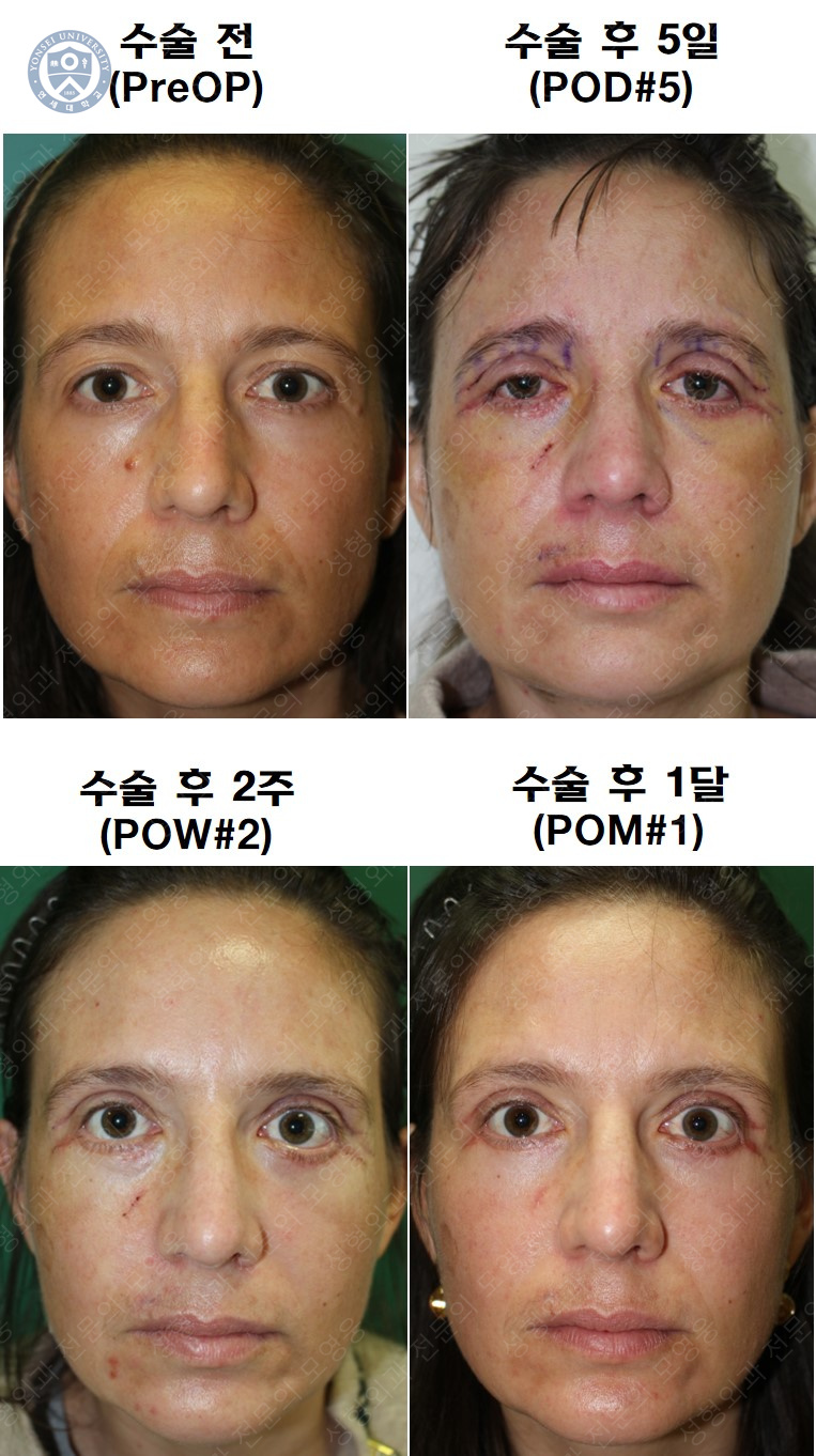 38세 서양 백인 여성, 쌍꺼풀 수술과 눈매교정 및 하안검성형술 (38/F Upper&lower blepharoplasty with levator plication) 관련 이미지 39