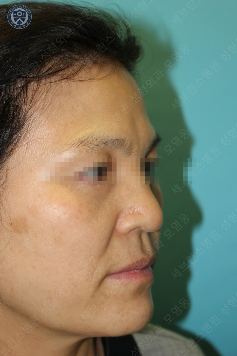 55세 여성, 이중평면 안면거상(55/F, Dual-plane full facelift) 관련 이미지 9