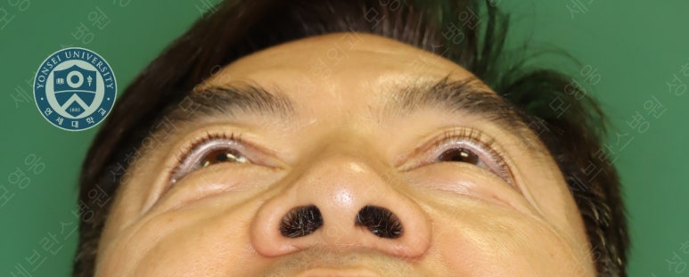 68세 남성, 하안검 성형술 및 안검외반 교정 증례(68/M Lower blepharoplasty & Ectropion correction with triamcinolone) 관련 이미지 4