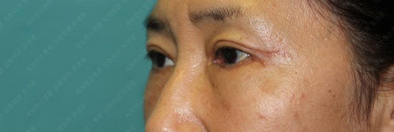 55세 여성, 상안검 및 하안검 성형술 증례 (55/F Upper & lower blepharoplasty) 관련 이미지 17