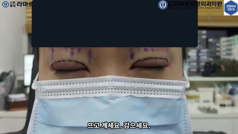 매몰 쌍꺼풀 풀고 절개쌍꺼풀로 바꾸는 쌍꺼풀 재수술!! 관련 이미지 47