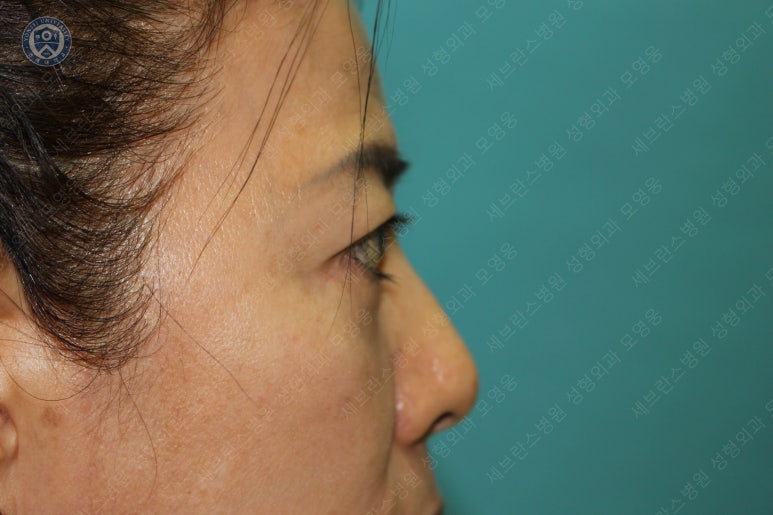 59세 여성, 그레이브스 안병증이 있는 돌출눈 중년 여성 하안검 성형술 (Lower blepharoplasty in Graves 관련 이미지 40