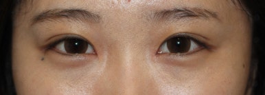 17세 여성, 쌍꺼풀+앞트임(DEO+Medial epicanthoplasty) 관련 이미지 22