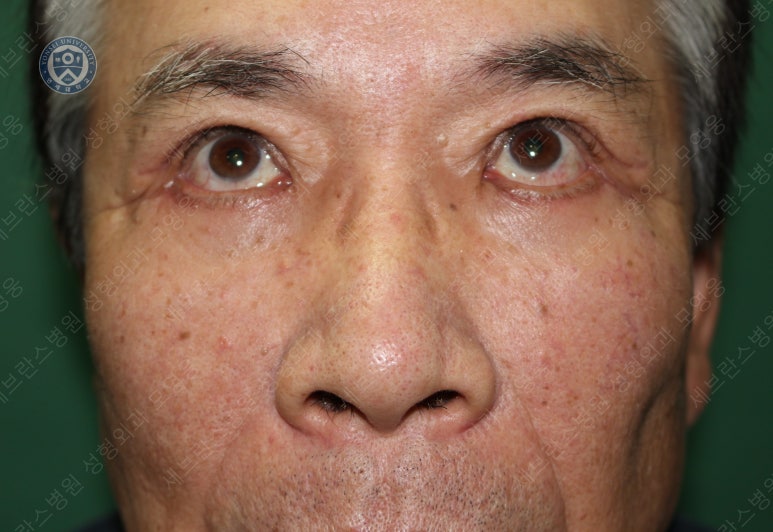 67세 남성, 상&middot;하안검성형술 및 안검하수교정 (67/M, Upper &  lower blepharoplasty with ptosis correction) 관련 이미지 31