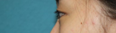 17세 여성, 쌍꺼풀+앞트임(DEO+Medial epicanthoplasty) 관련 이미지 5