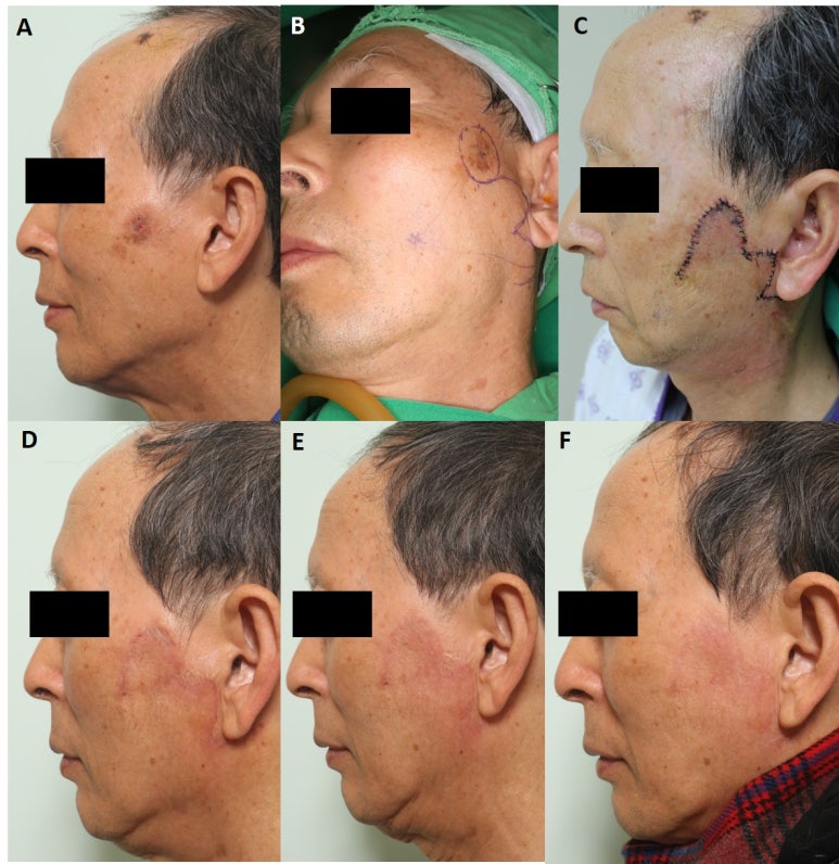 Medicine - Comparison of the recurrence rate of 3 treatmentmodalities for BD in an aging city 관련 이미지 11
