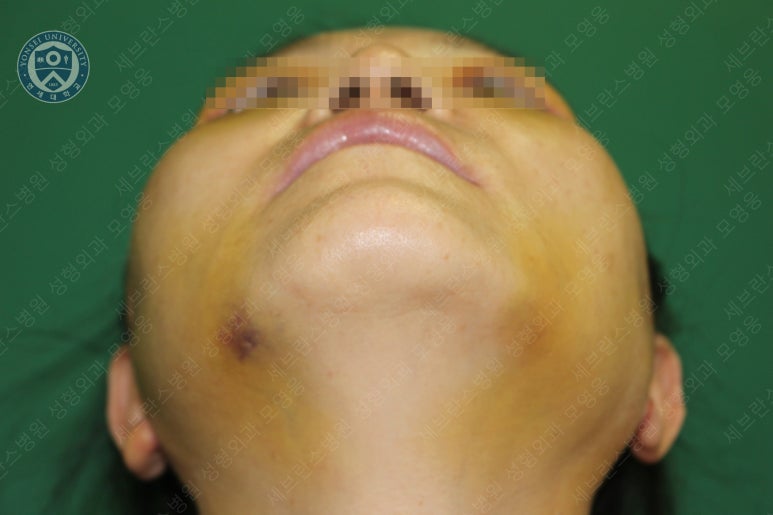 55세 여성, 이중평면 안면거상(55/F, Dual-plane full facelift) 관련 이미지 23