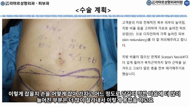 '복부성형술+지방흡입(Abdominoplasty+PAL)' 으로 뱃살 끝장내기! 관련 이미지 34