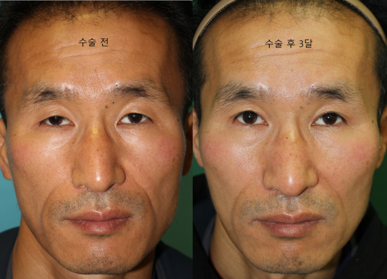 남자눈성형: 무쌍눈매교정 (Blephroptosis correction-levator aponeurosis advancement) 관련 이미지 45