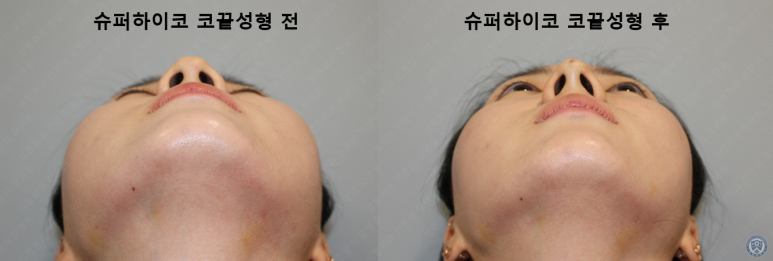 27세 여성 최소침습 코끝성형 시술영상 관련 이미지 3