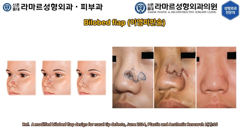 지름 1cm 코 점 제거수술 : 나선피판술(Spiral Flap) 수술전~1달 경과. (Feat. 턱끝필러+사각턱 보톡스) 관련 이미지 32