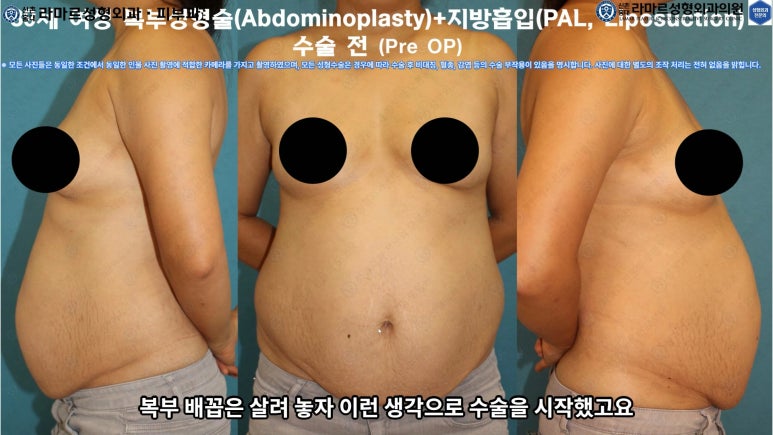 '복부성형술+지방흡입(Abdominoplasty+PAL)' 으로 뱃살 끝장내기! 관련 이미지 36