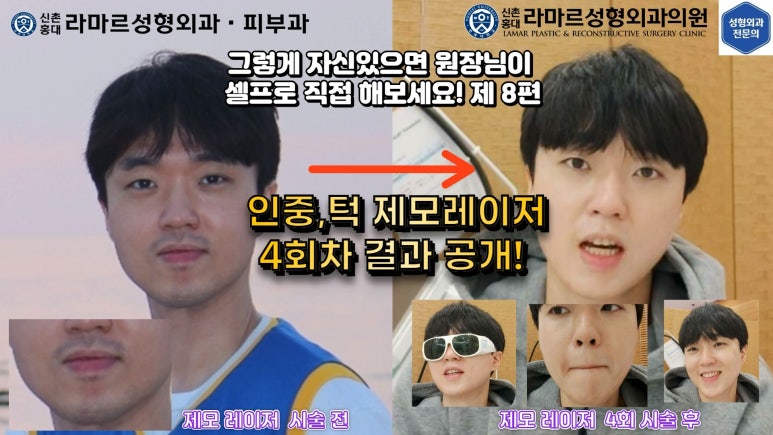 [성형외과 전문의의 셀프시술 제8편] 인중, 아래턱 제모 4회차 결과 공개! 관련 이미지 5