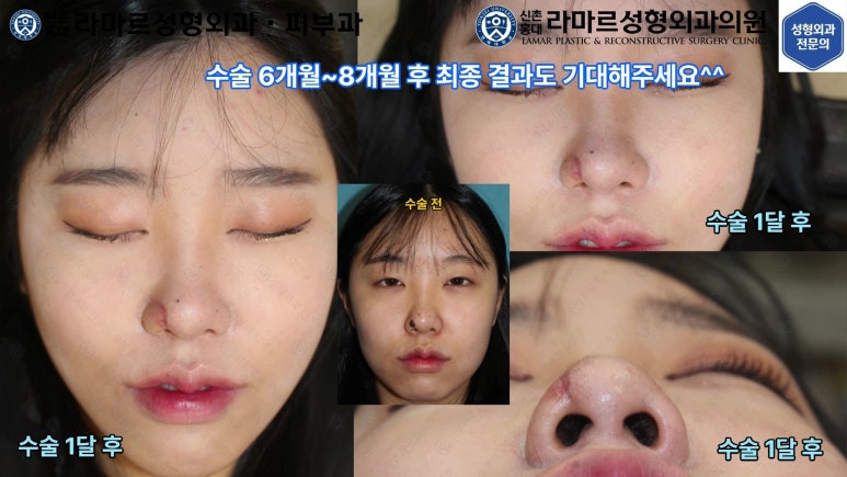 21세 여성 코 지름 1cm 점 제거수술 : 나선피판술(Spiral Flap) 수술전~5달 경과. (+쌍꺼풀수술, 코필러) 관련 이미지 8